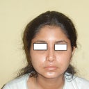 front - 3weeks post op