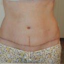 4 months PO of incisions. Vertical still pulls in.