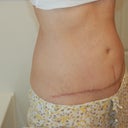 4 months PO...Angled view of bulge from vertical.