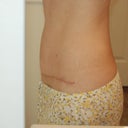 4 months PO...Right side.