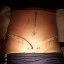 Day 10 post-op  Drain 3 pulled...1 to go!