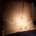 Day 10 Post-Op DRAIN FREE!