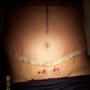 Day 10 Post-Op Another view - still laying down.
