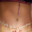 Day 10 Post-Op  Just the thought of my flat tummy is so excited!  Can't wait till I can work my abs again!