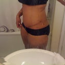 2 months post op 
scar