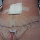 2 drains out of pubic area
