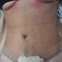 4 days po -new tummy and belly button! It's swollen and it still looks better than my before pics!!