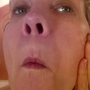 left cheek.. you can only see it in certain lights, but they are sometimes painful. THis is after several treatments to break them up.