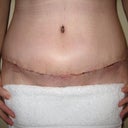 2 weeks post op