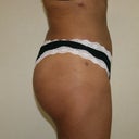 Post op 5 weeks