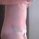 8 days po-side view. still can't stand up straight