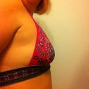 pre-op side view
