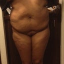 Pre-op: Frontal