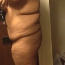 Pre-op: (Right) Side