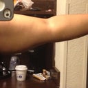 Pre-op: (Left) Arm