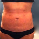 6 hours after the procedure