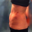 6 hours after Smartlipo (side shot)