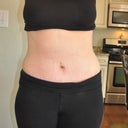 2 weeks PO..swollen!