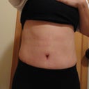 2 weeks post op (Scabs in belly button)