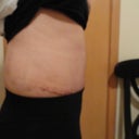 2 weeks post op side view