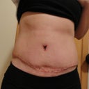 2 weeks post op scar - ew - doc said it should smooth out nicely though