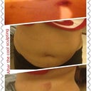 after i got the cool sculpting in my lower and two upper abdominal area