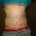 18 Days PO.  The swelling has gone down quite a bit in just 4 days!