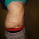 18 Days PO. You can see the swelling in my back and love handles right here, but hey!  Look at that flat tummy, Jack! :)
