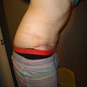18 Days PO.  Oooo, bending over and not having a puddle of skin to follow!