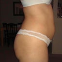 This my before three days before my surgery.