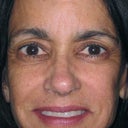 Cheek Lift In 49 Year Old Woman