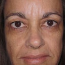 Cheek Lift In 49 Year Old Woman