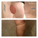 Top: 1 month 4 days post op.
Bottom: pre-post