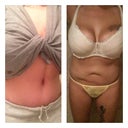 Top: 1 month 4 days post op.
Bottom: pre-post