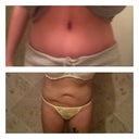 Top: 1 month 4 days post op.
Bottom: pre-post