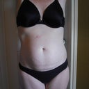 Before tummy tuck