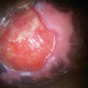 right breast infected
