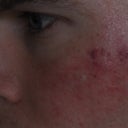 Brusing 1 day after V Beam. My whole cheek was swollen for a few days.