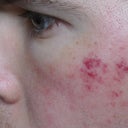 Brusing 3 days after V Beam.