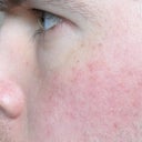 1 week after V Beam.  Background redness is still there, but it doesn't seem to flare.