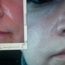 11 days after surgery. Worried about the direction of my skin in between my nostrils. Seems different then before