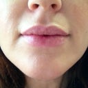 1 week after treatment.