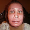 After Flexan dressing removal. Three days after.