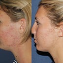 Before & After Fraxel Restore