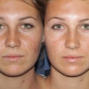 Before & After Fraxel Restore