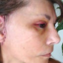 showing side after revision, fullness visible