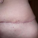 14 weeks 2 days PO .......dog ear....looks like a nipple on my hip!