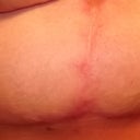 right breast scar