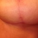 left breast scar