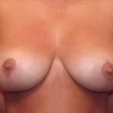 front view of breast